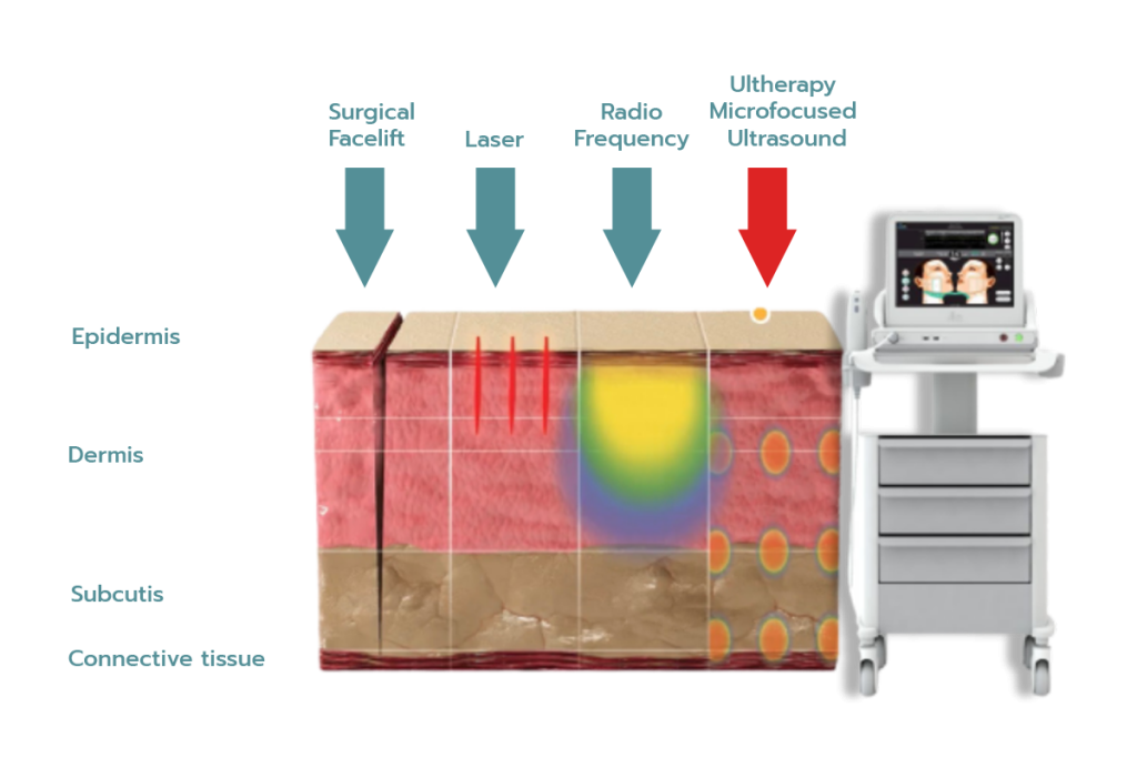 Thumbnail Ultherapy